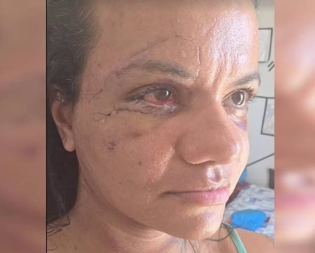 Dias após cirurgia, vítima agredida com 61 socos mostra seu rosto pela primeira vez