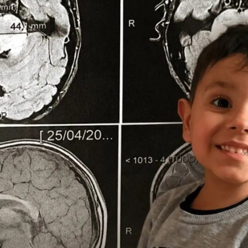 Após diagnóstico devastador, família luta para garantir qualidade de vida a menino com tumor raro no cérebro
