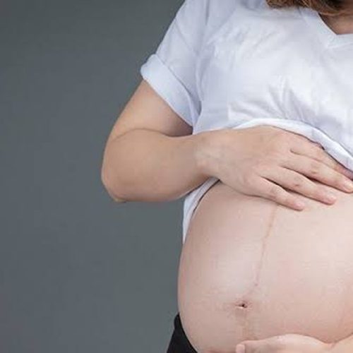 Cesariana pode aumentar em 45% risco de câncer raro ligado à placenta