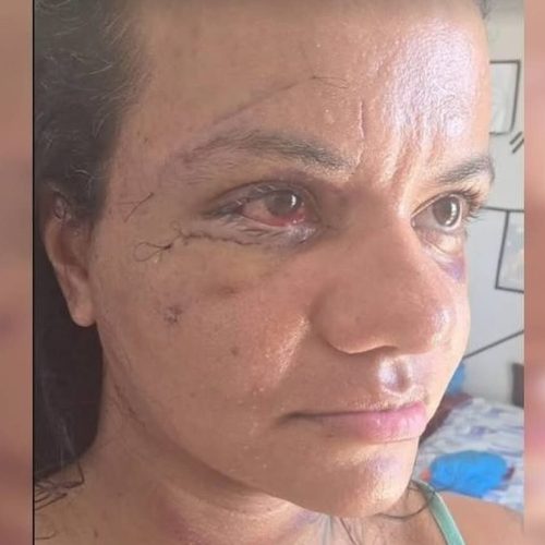 Dias após cirurgia, vítima agredida com 61 socos mostra seu rosto pela primeira vez