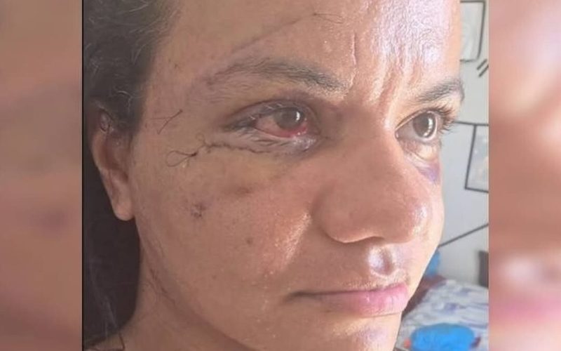 Dias após cirurgia, vítima agredida com 61 socos mostra seu rosto pela primeira vez