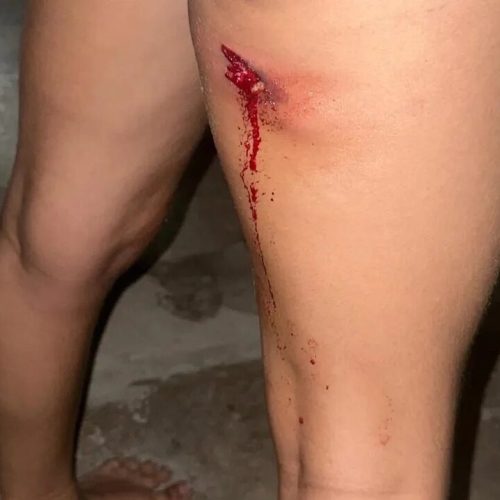 Torcedora denuncia ferimento por bala de borracha em confusão no Rei Pelé