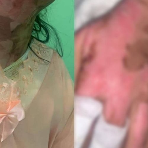“Ele disse que ia me matar”; adolescente denuncia ex-namorado por tortura, ataque com fogo e ameaças de morte em Maravilha