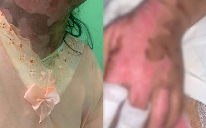 “Ele disse que ia me matar”; adolescente denuncia ex-namorado por tortura, ataque com fogo e ameaças de morte em Maravilha