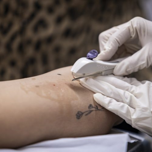 Secretaria de Saúde de Maceió já ofereceu implante contraceptivo gratuito a quase 700 mulheres em dois meses