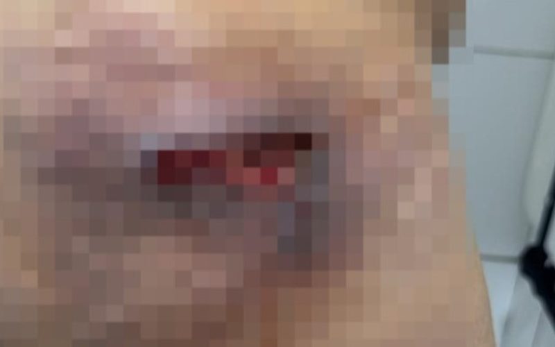 Dentista é investigada por aplicar silicone industrial em pacientes em Arapiraca